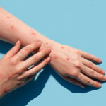 VARÍOLA DOS MACACOS CHEGA A MINAS GERAIS, JÁ SÃO TRÊS CASOS CONFIRMADOS!